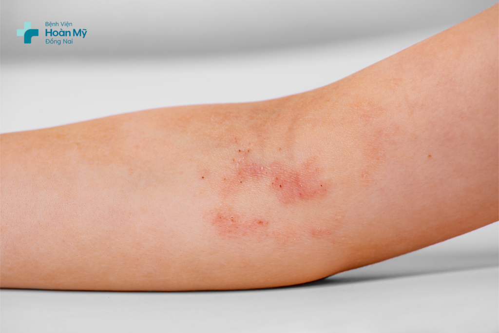 Viêm da tiếp xúc thực vật ánh sáng