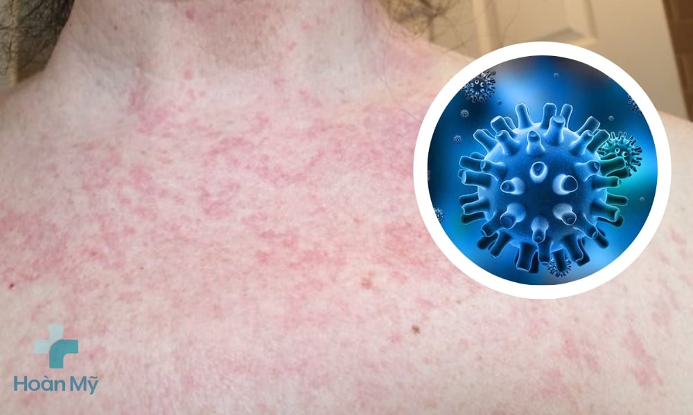 Do virus Herpes 6, 7