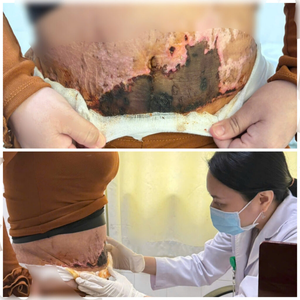 Người phụ nữ 31 tuổi bị biến chứng hoại tử da bụng sau phẫu thuật hút mỡ