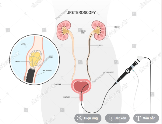 Điều trị sớm sỏi niệu quản để tránh các biến chứng về thận
