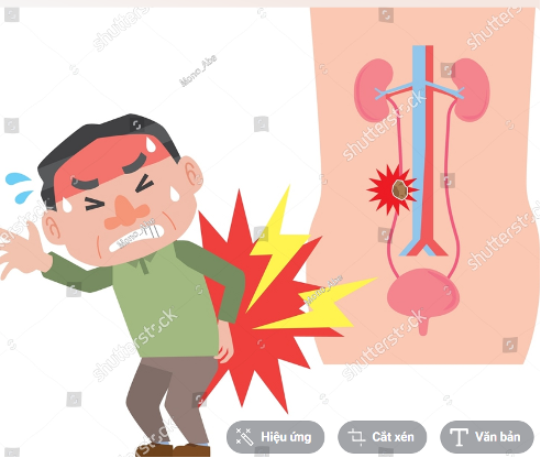 Hình 3: Sỏi niệu quản tắc nghẽn gây cơn đau quặn ở vùng hông lưng