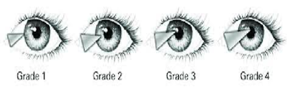 Phẫu thuật mộng thịt và ghép kết mạc tự thân