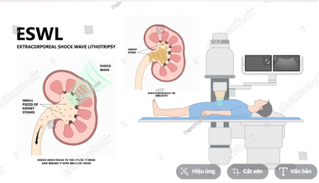 Hình 4: Tán sỏi ngoài cơ thể là biện pháp điều trị can thiệp ít xâm lấn, ít đau, mang lại hiệu quả cao cho sỏi vừa và nhỏ ở các vị trí thích hợp