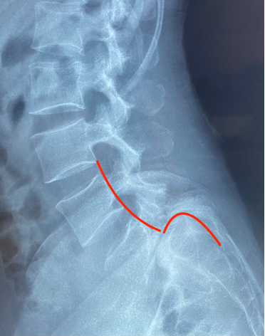 Trượt thân sống độ IV - Thành công phẫu thuật giảm tổn thương