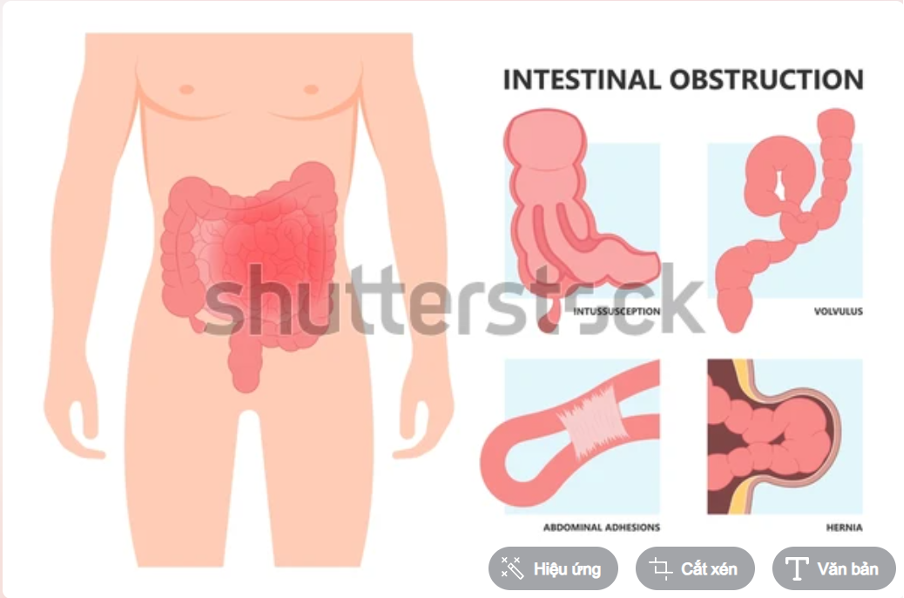 Các loại tắc ruột thường gặp: Nguyên nhân và cách điều trị