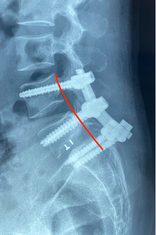 Trượt thân sống độ IV - Thành công phẫu thuật giảm tổn thương