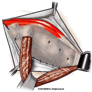 Phẫu thuật điều trị thoát vị bẹn bằng phương pháp Lichtenstein (Gây tê, mổ hở)
