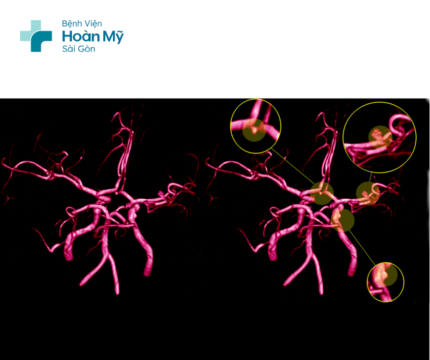 Các vị trí túi phình mạch não thường gặp và cách điều trị
