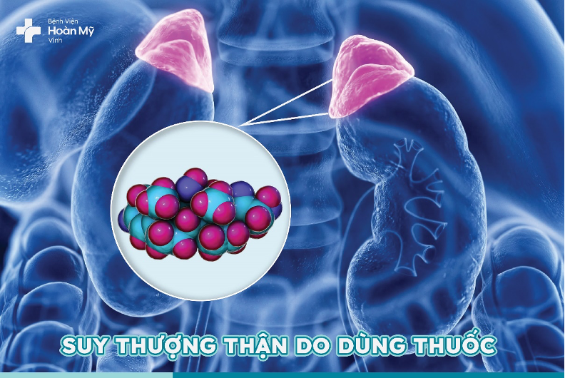 Cảnh báo tình trạng suy thượng thận do dùng thuốc nhóm Corticoid