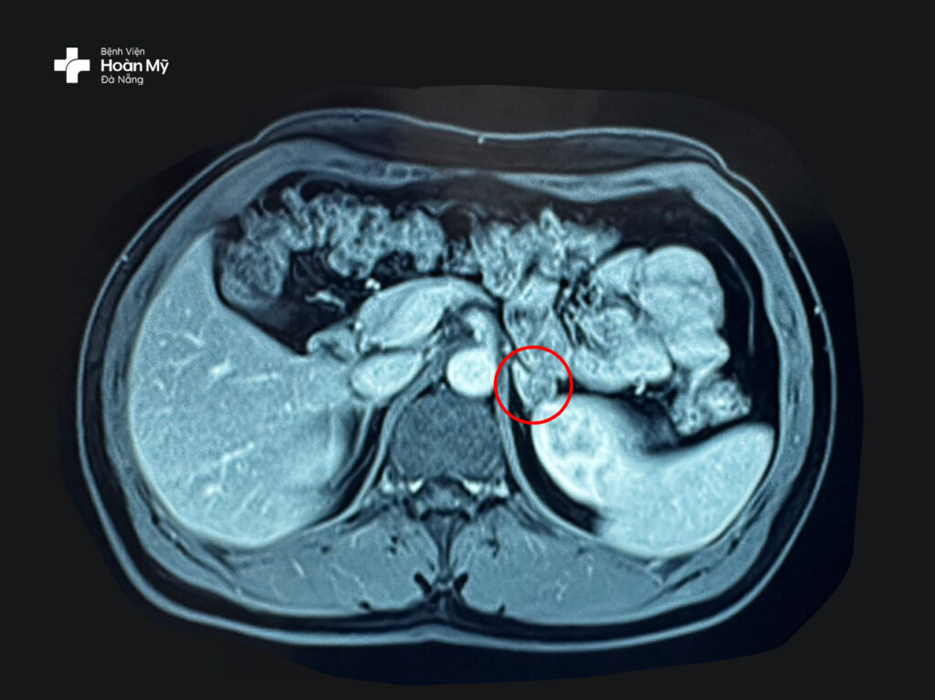 Hình ảnh khối u tuyến thượng thận nhỏ được thể hiện rõ trên MRI