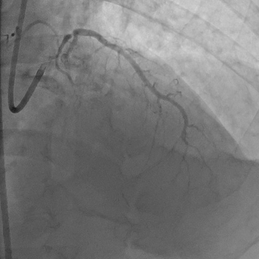 Bệnh Viện Hoàn Mỹ Sài Gòn Cứu Sống Kịp Thời Một Bệnh Nhân Đột Quỵ Cấp