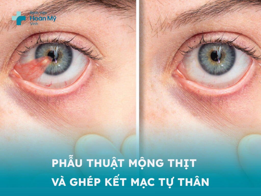 Phẫu thuật mộng thịt và ghép kết mạc tự thân