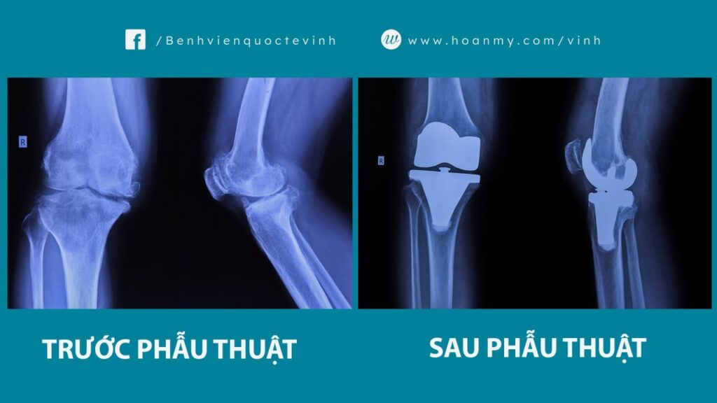 Khôi phục vận động sau phẫu thuật thay khớp gối toàn phần cho người bệnh 60 tuổi