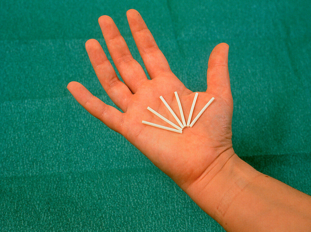 Que cấy Norplant có tác dụng tránh thai lên đến 7 năm