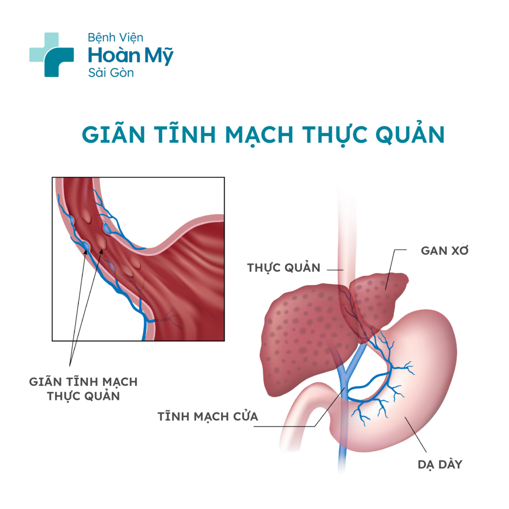 Cách điều trị giãn tĩnh mạch thực quản hiệu quả