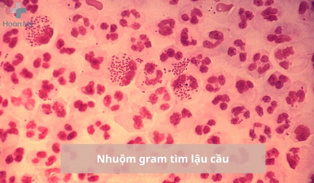 Tìm lậu cầu bằng cách nhuộn gram