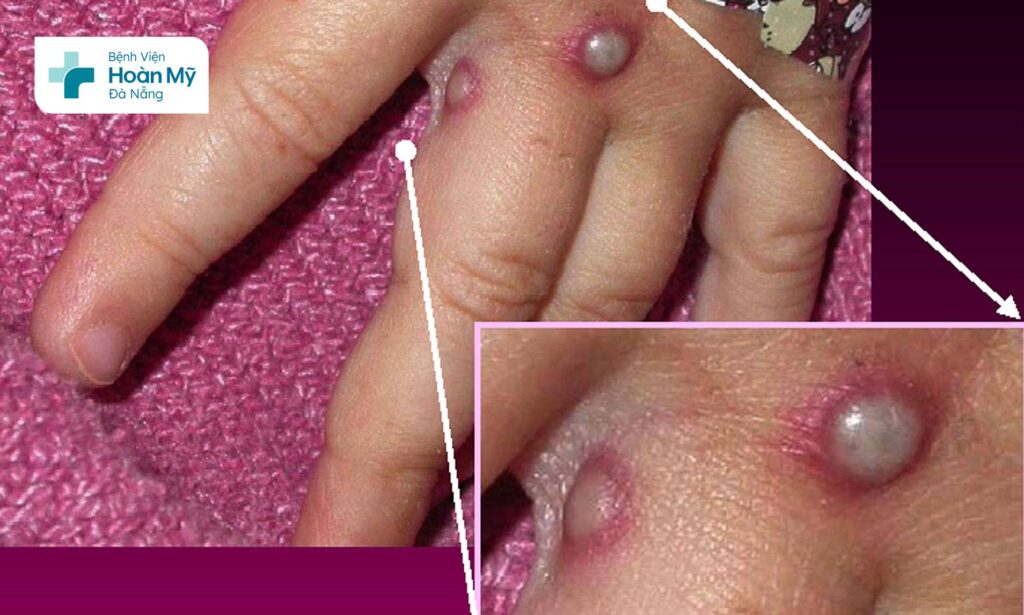 Sốt, nhức đầu, đau cơ và kiệt sức là những triệu chứng thường gặp của bệnh đậu mùa khỉ giai đoạn đầu