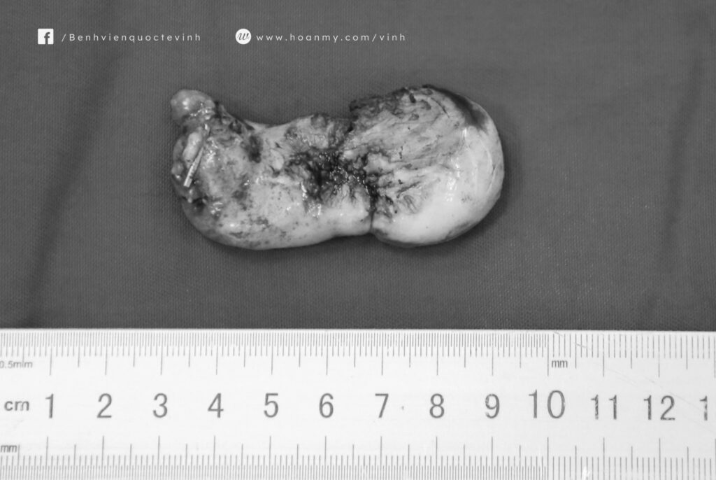 Hình ảnh túi mật sau khi cắt bỏ